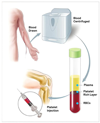 Post-PRP Injection Care